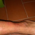 La caviglia infortunata… del nostro lettore